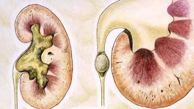腎結(jié)石是怎么引起的？