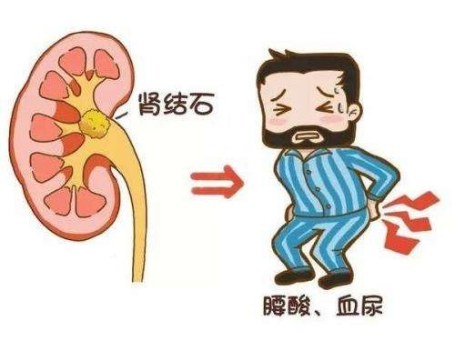 得了腎結(jié)石怎么辦？